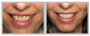 Smile Makeover Before and After Pictures